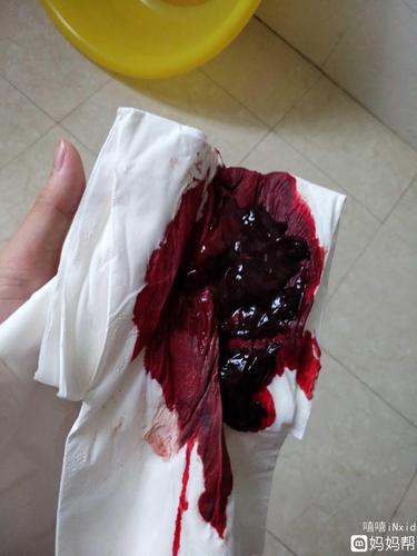 例假血块排出像猪肝正常吗(恶露排出猪肝状大块）