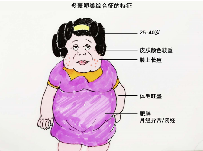 警惕多囊卵巢综合征要注意什么(为什么会突然得多囊卵巢综合症）