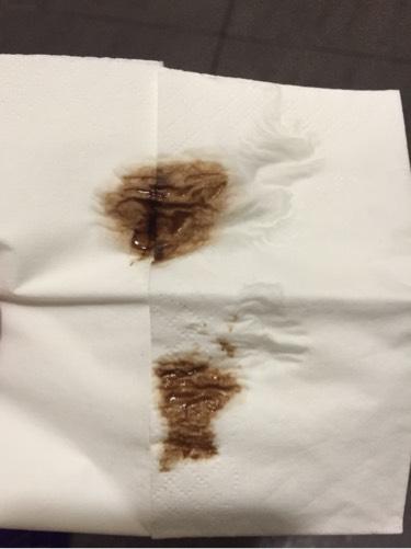 褐色的白带如何调理(黑褐色分泌物怎么回事没来月经）