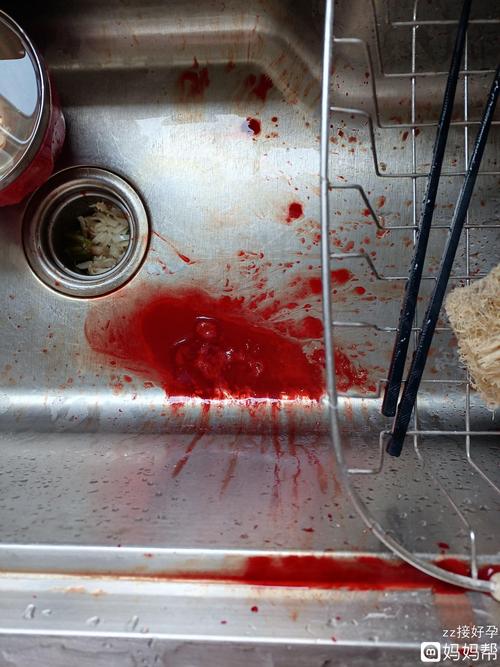 前列腺钙化会不会变癌癌症真的这么容易得吗？(前列腺钙化离前列腺癌不远了）