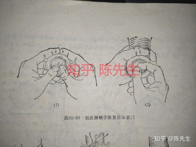 包茎嵌顿复位后什么样