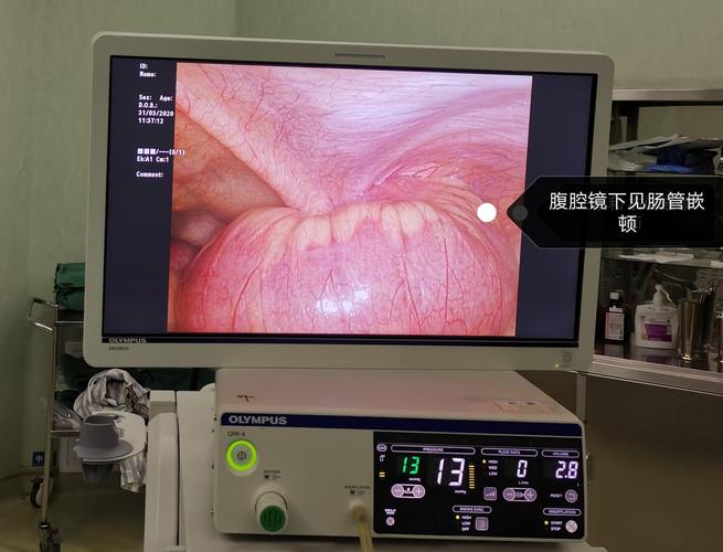 包茎嵌顿复位后什么样