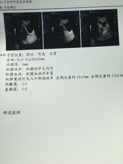 卵泡20x15容易受孕吗(卵泡27x15怀孕流产）