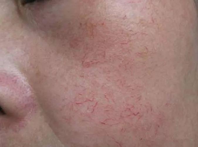 分泌物有血丝怎么回事(白带里有轻微血丝是怎么回事)