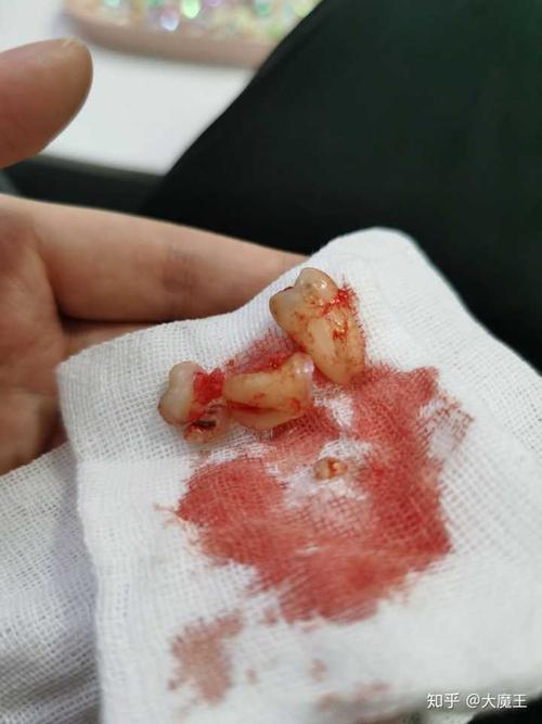 老公拔牙可以怀孕吗(拔牙打麻药当月怀孕了）