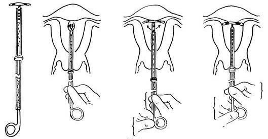 什么是避孕器(子宫内避孕器）