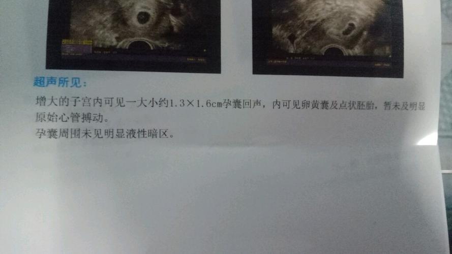 同房后两个月孕囊多大(孕囊多大mm时有卵黄囊)