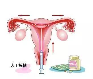 做人工授精疼不疼不要太心慌(人工授精疼不疼女性）