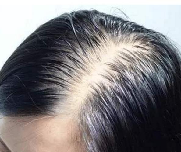 六个常见原因引起女人脱发(上消化道出血最常见的原因)