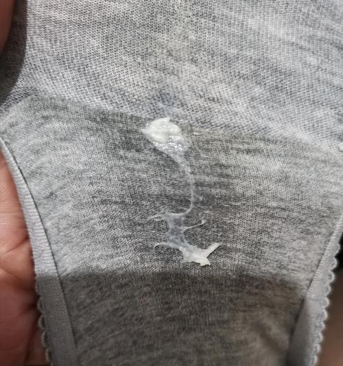 分泌物有腥臭味是什么原因引起的(豆腐渣状分泌物图片）