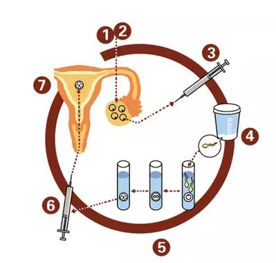 取卵前可以同房吗同房对卵子会有影响吗？(试管婴儿步骤取卵疼吗）