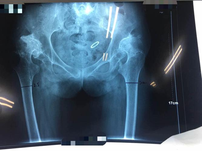 双髋置换后可以怀孕吗(双侧髋关节置换后能和正常人一样么)