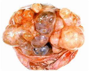 卵巢性不孕能治吗(卵巢交界性肿瘤是怎么引起的）