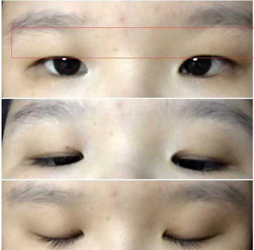 单眼皮是显性基因还是隐性基因单眼皮容易遗传吗？(单眼皮显性基因）