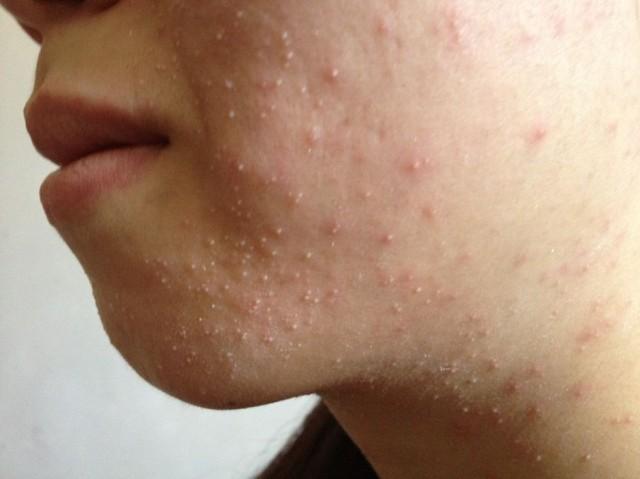 体寒的人容易长痘痘吗(为什么体寒的人容易长痘）