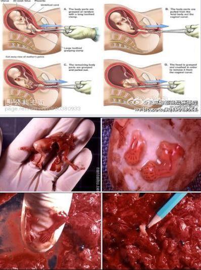 人流不孕不育几率大吗(打胎过后有多大几率怀不上）