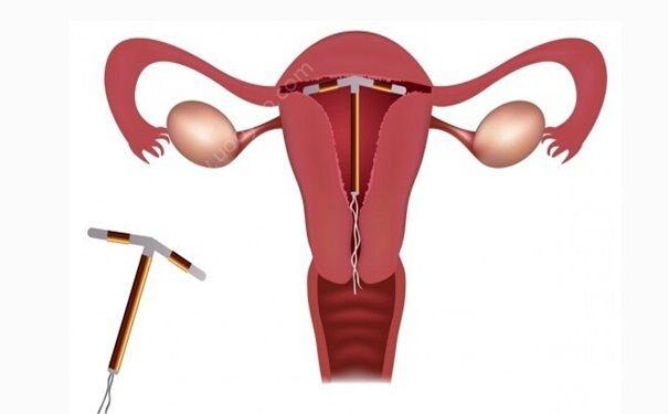 取环多久怀孕最好(取环最快多久可以同房）