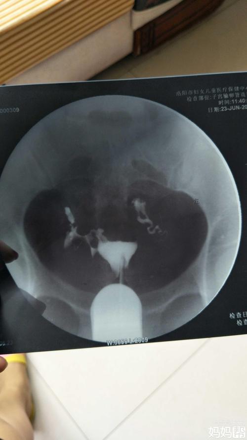 输卵管炎会自己好吗(输卵管上举图片位置示意图）