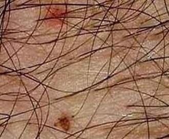 阴虱会乱爬吗阴虱真的会爬遍全身吗?(阴虱会爬到孩子身上吗)