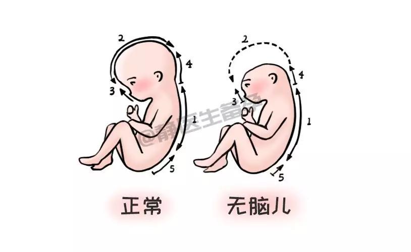 胎儿无脑畸形再备孕可以吗(有一胎畸形下胎还会吗）