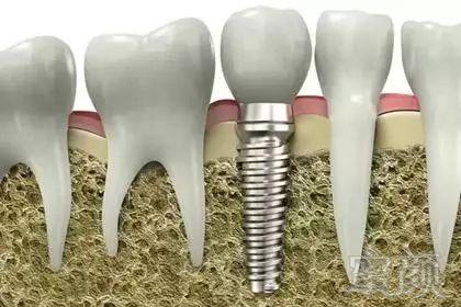镶牙后可以怀孕吗(为什么医生建议镶牙不要种牙）
