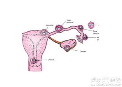 输卵管切除一边还可以怀孕吗(宫外孕说明男人的精子）