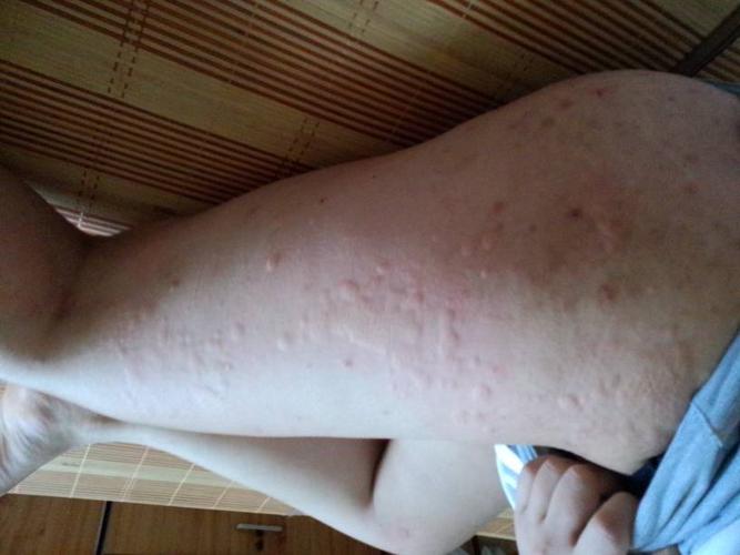 荨麻疹对怀孕有影响吗(慢性荨麻疹怀孕了对宝宝有没有影响）