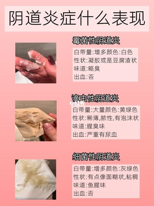                                                                                 豆腐渣是继女性尿道口排出的白色组织,也称为白带