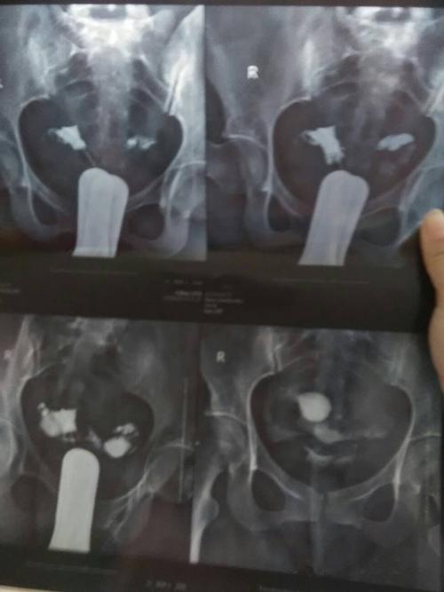 输卵管介入后多久怀孕(输卵管介入术后怀孕几率大吗）