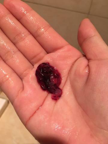 自然流产为什么没有血(生化妊娠有不流血的吗）