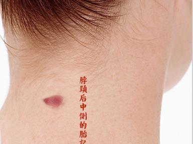 胸前有胎记代表什么(男人胸前有胎记好吗）