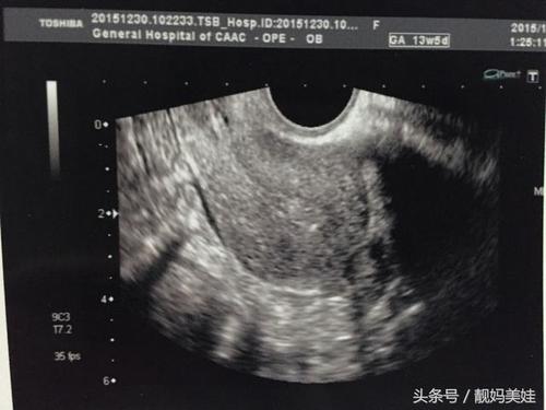 阴超和b超的区别有哪些(妇科b超和阴超哪个好）