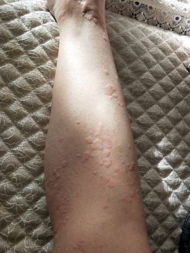 荨麻疹对怀孕有影响吗(慢性荨麻疹怀孕了对宝宝有没有影响）