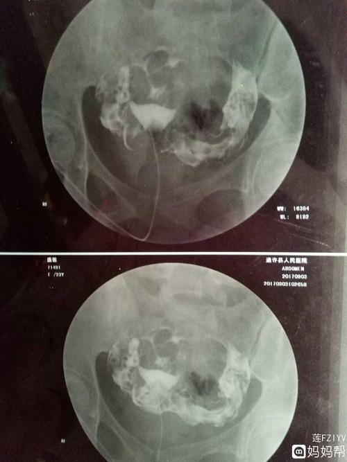 输卵管伞端粘连有救吗(输卵管伞端不通严重吗）