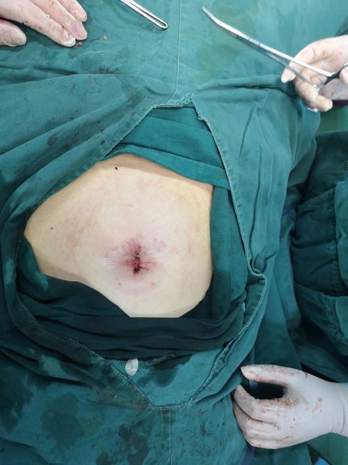 输卵管通而不畅怎么治(通水后什么症状是通了）