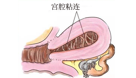 轻度宫腔粘连需要手术吗(子宫粘连一定要做手术吗)