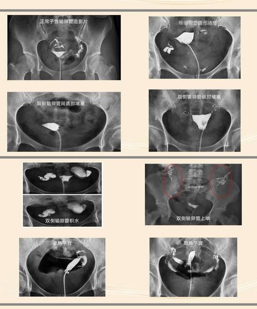 输卵管造影检查痛苦吗(正常输卵管造影图）