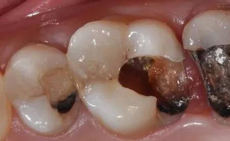 蛀牙怀孕前一定要拔吗(龋齿不拔对怀孕的影响）