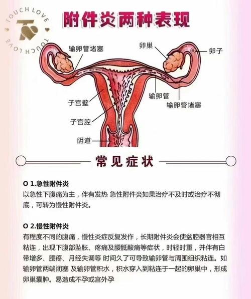 输卵管炎是附件炎吗(盆腔炎是输卵管炎吗）