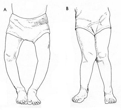 罗圈腿会不会遗传罗圈腿是遗传病吗？(o型腿会遗传给下一代吗）