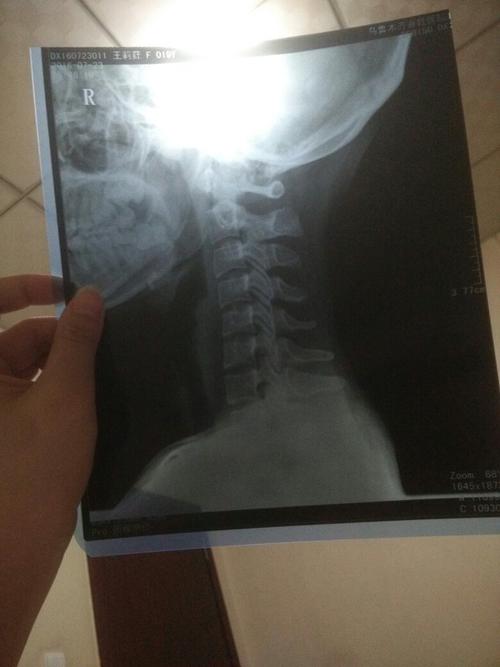 颈椎正侧位备孕可以拍片吗(做了颈椎ct后多久才能要孩子）