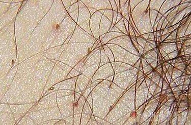 阴虱要看什么科室去医院不要搞错科室(阴虱怎么来的）