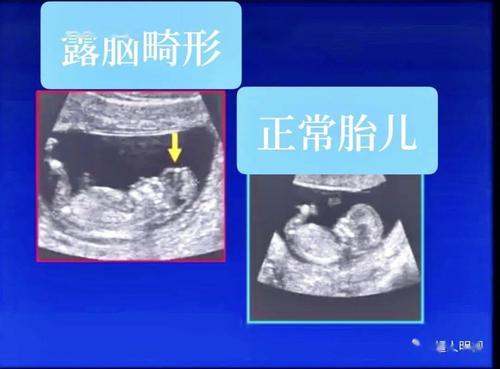 胎儿无脑畸形再备孕可以吗(有一胎畸形下胎还会吗）