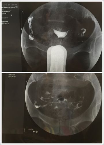 输卵管伞端粘连能自然怀孕吗(做了腹腔镜一年了怀不上）