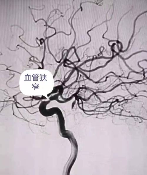 输卵管造影备孕的方法是怎样的(造影为什么有助于怀孕）