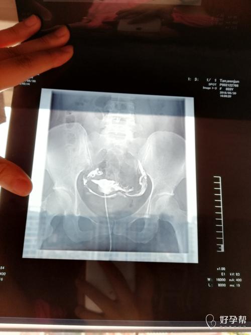 输卵管造影后多久可以要孩子(做输卵管造影术后悔了）