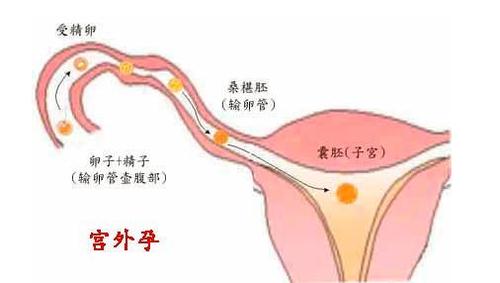 输卵管切除一边还可以怀孕吗(宫外孕说明男人的精子）