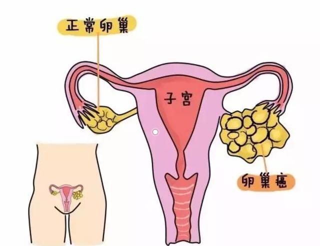 远离这5件事，你的卵巢将重获新生！(什么是卵巢）