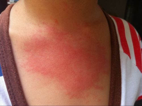 风疹病毒会影响怀孕吗(风疹图片初期症状图片）