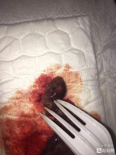 自然流产最常见的原因是什么？它们主要与这三点有关(早期自然流产有啥感觉）